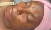 Up to 53% Off on Facelift - Non-Surgical at Clinical Complexions Llc