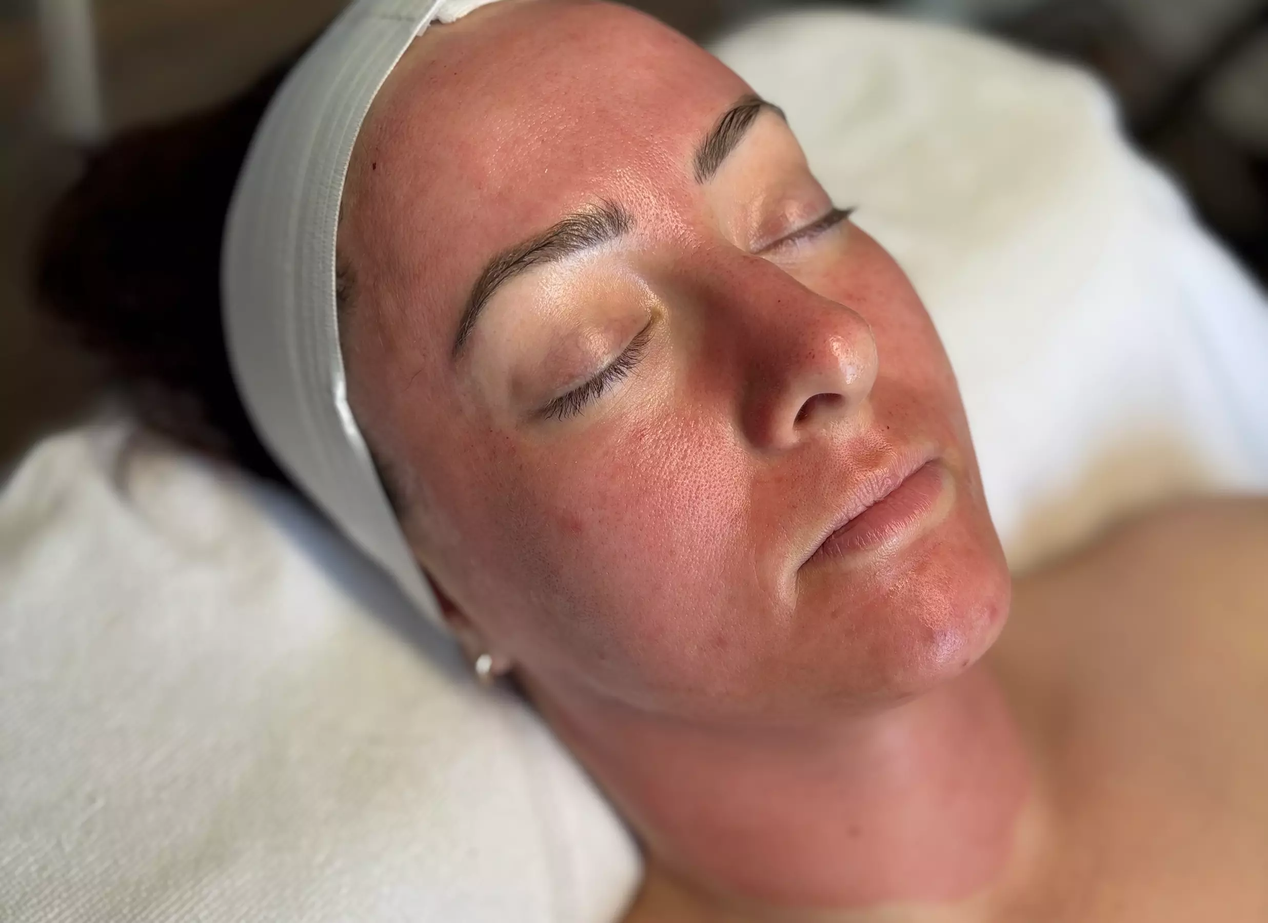 Up to 35% Off on  at Dermatone Skincare Studio