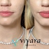 Image 3: Enhance your look with Vivara Med Spa's Revanesse Lip Filler and Versa+ Injections up to 33% off for a radiant appearance