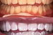 Up to 15% Off on Teeth Whitening at Pearl Glow Smiles - Second Medium