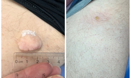 Up to 3 Skin Tags / Milia / Blood Spot / Mole Wart Removal 45 minute session - Soft Soles Beauty And Aesthetics