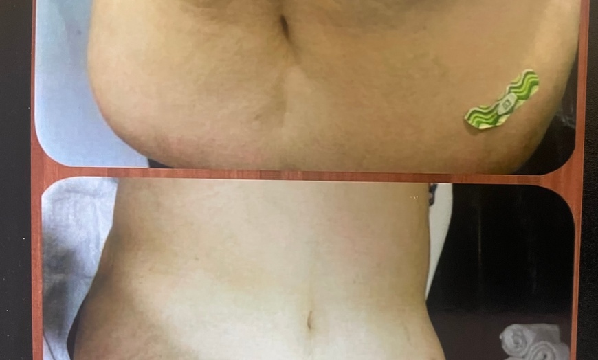 Image 4: Transform Your Body with Two or Four Laser Liposuction Sessions