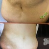 Image 4: Transform Your Body with Two or Four Laser Liposuction Sessions