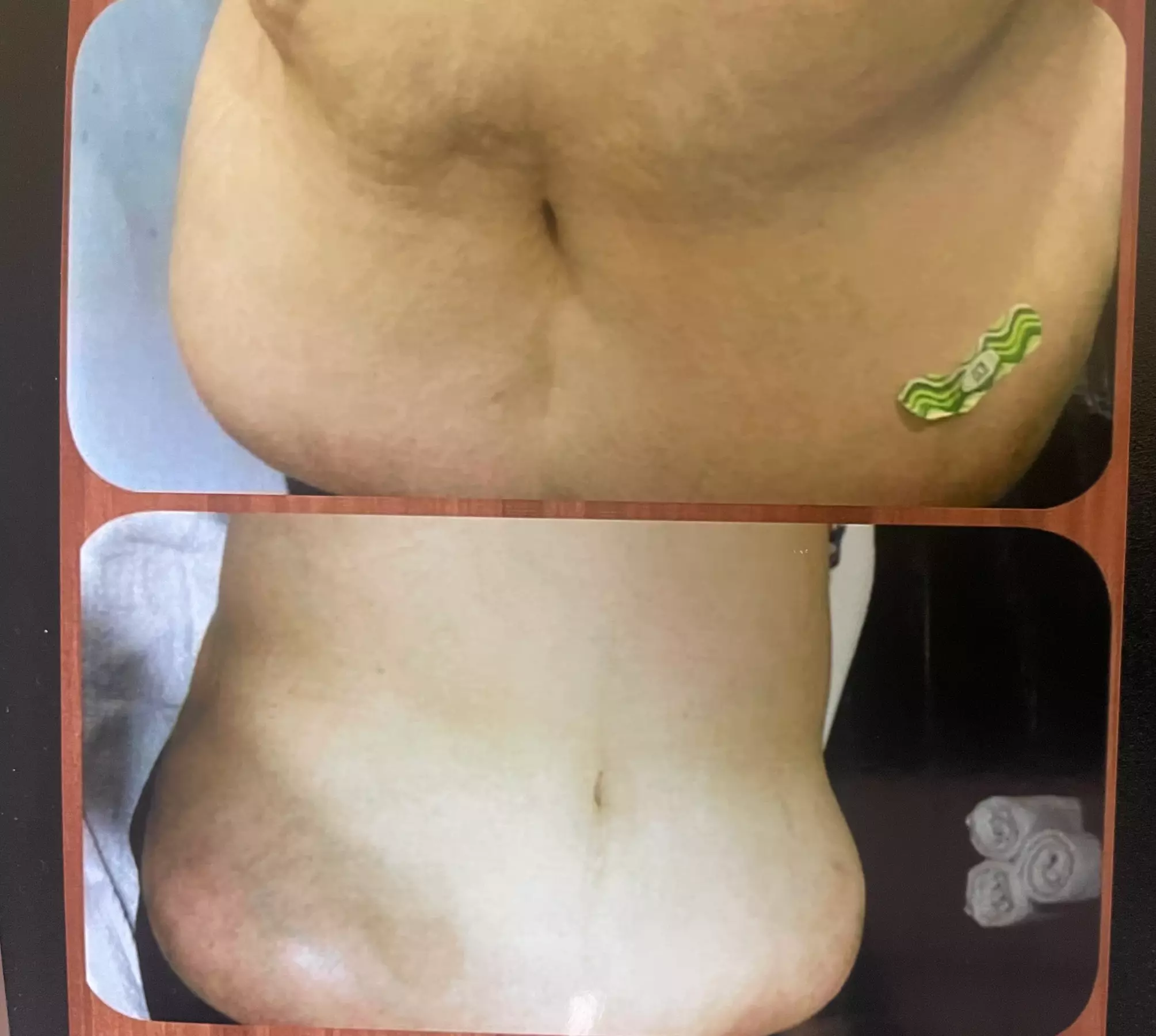 Transform Your Body with Two or Four Laser Liposuction Sessions