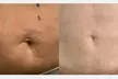 Up to 80% Off on Ultrasonic Fat Reduction at Renew Contouring - Second Medium