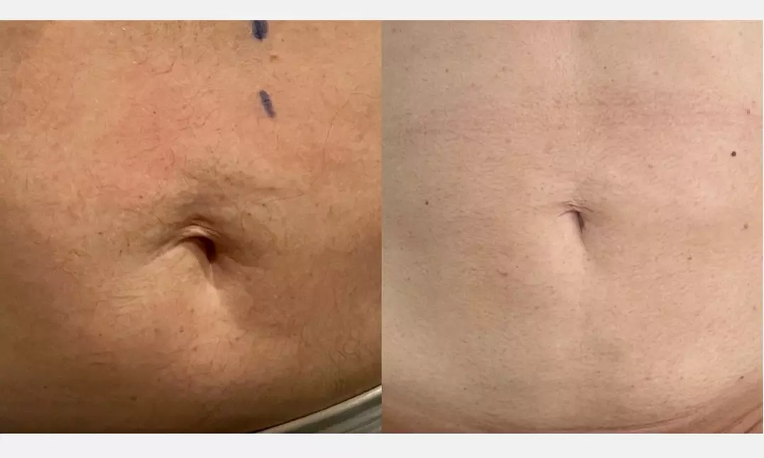Up to 80% Off on Ultrasonic Fat Reduction at Renew Contouring