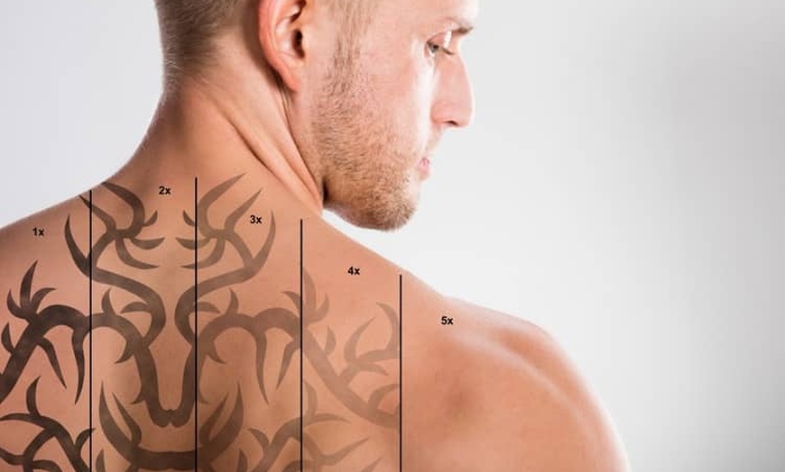 Image 2: 1 or 2 Sessions of Laser Tattoo Removal on Area Up to 5cm and More