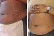 Up to 50% Off on Fat / Cellulite Reduction - Non-Branded at Noire Aesthetics - Second Medium