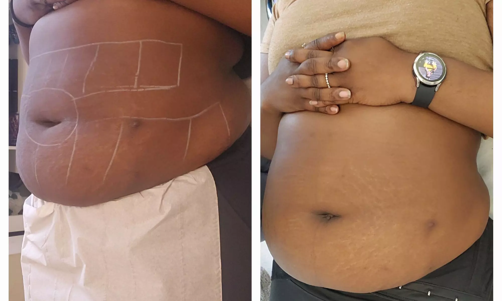 Up to 50% Off on Fat / Cellulite Reduction - Non-Branded at Noire Aesthetics