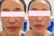 ✨One HIFU Treatment for Under Chin, Face, or Abdomen for Firming Results at SkinVital Studio Up To  46% Off✨ - Second Medium