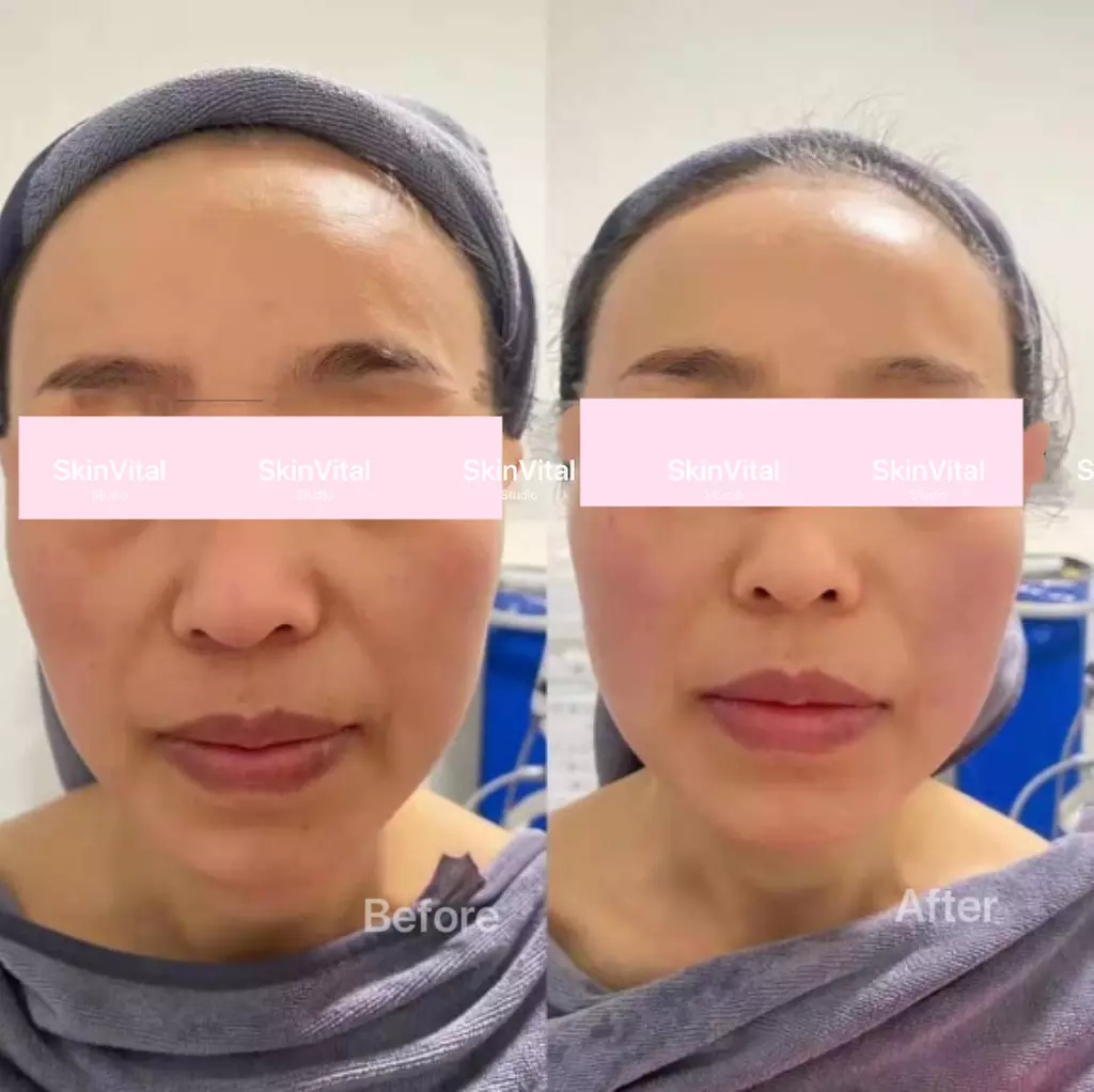 Targeted HIFU Lifting for Chin, Face, or Abdomen