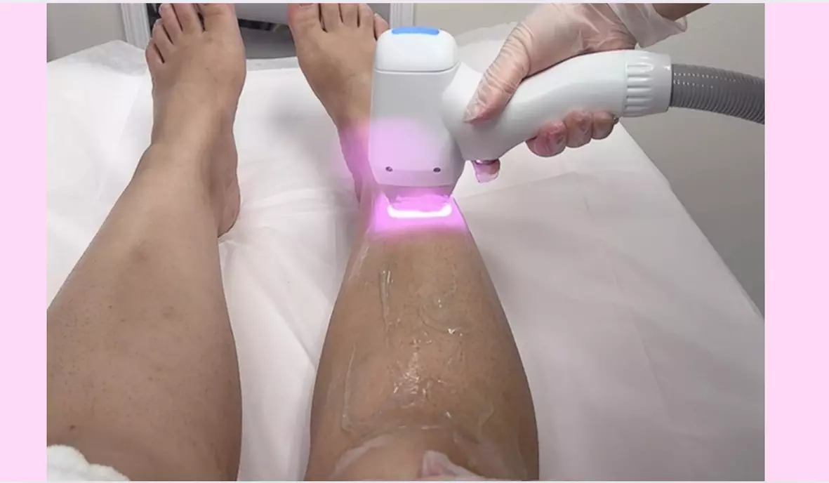 Up to 31% Off on Laser Hair Removal at Sara Aesthetics LLC