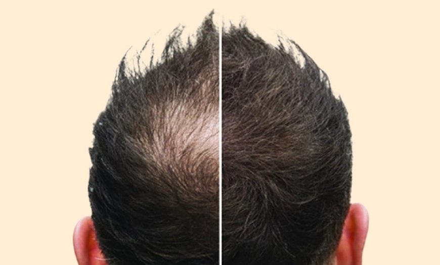 Image 3: Rejuvenate with One or Four Sessions of PRP Hair Restoration