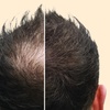 Image 3: Rejuvenate with One or Four Sessions of PRP Hair Restoration