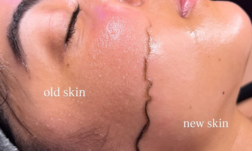 Image 1: Revitalize Your Face w/ One or Three Chemical Peels with Dermaplaning 