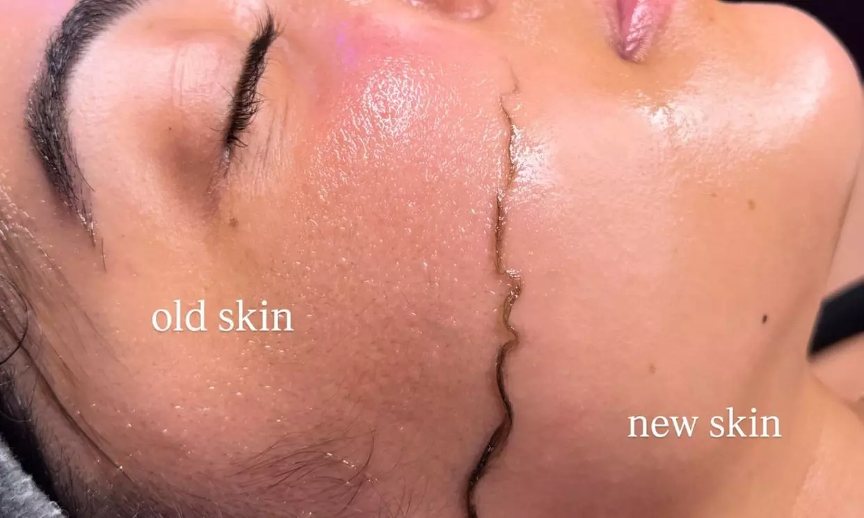 Revitalize Your Face w/ One or Three Chemical Peels with Dermaplaning