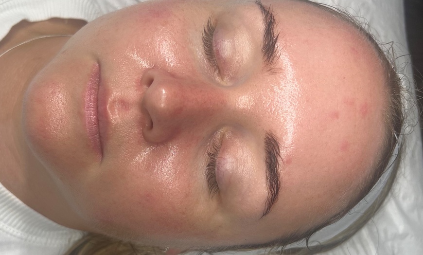 Image 10: Up to 59% Off on Facial - HydraFacial at RefreshSkinTherapy