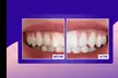Up to 67% Off on Invisible Aligners Full Treatment - StarSmiles Aligners - Second Medium