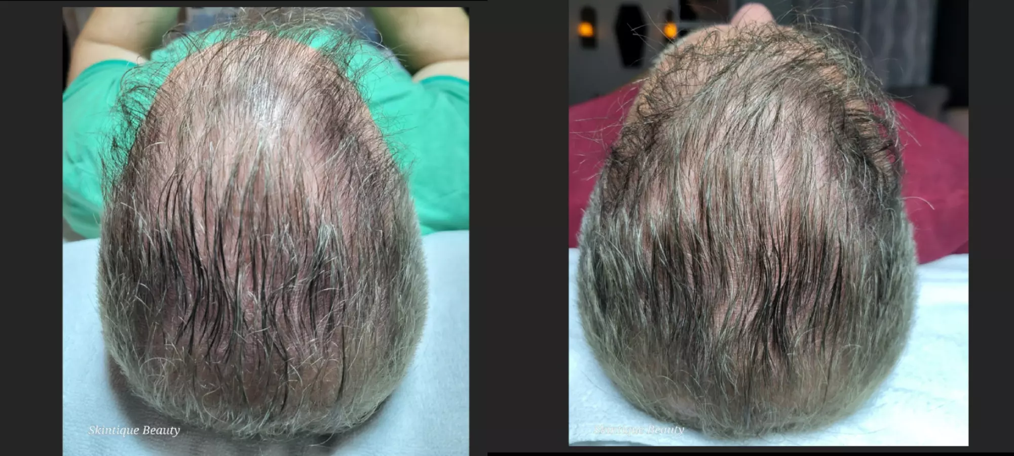 Experience One or Three Sessions of Cold Plasma Hair Growth & Red LED