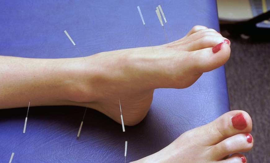 Image 3: Holistic Healing with Acupuncture or Fire Cupping + Biofeedback