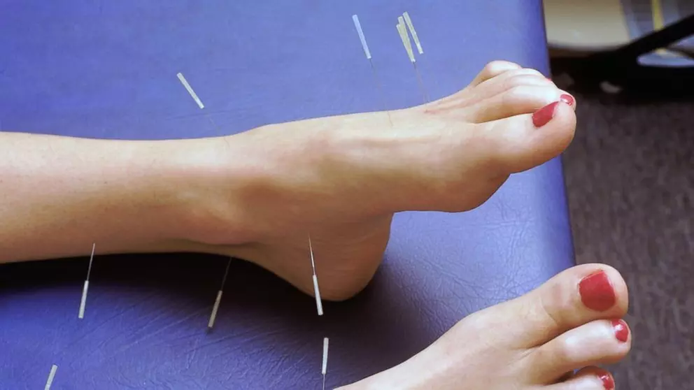 Holistic Healing with Acupuncture or Fire Cupping + Biofeedback