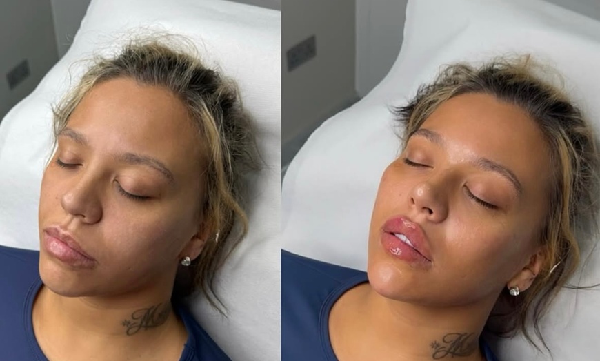 Image 8: Revitalize with 20, 40, or 60 Units of Botox for a Smooth Look