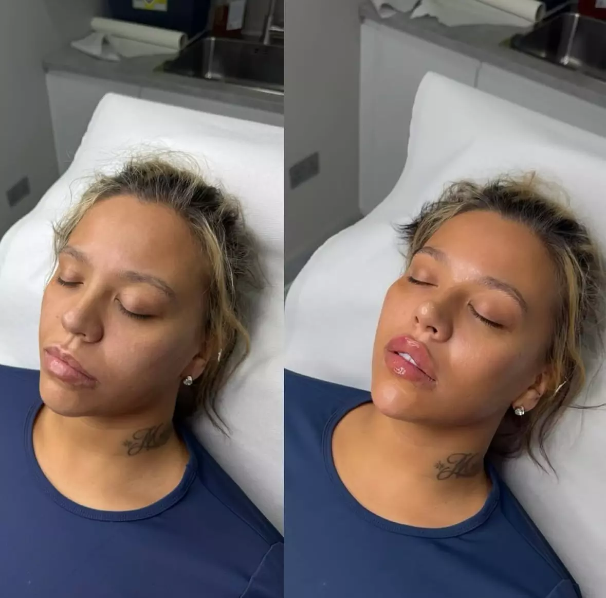 Revitalize with 20, 40, or 60 Units of Botox for a Smooth Look