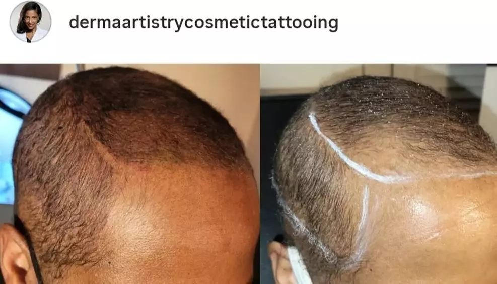 Up to 50% Off on Men and Women's Scalp Micropigmentation