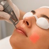 Image 2: Up to 45% Off on Laser Skin Resurfacing at Turkish Royal Aesthetic