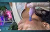 Up to 59% Off on Micro-Needling at Aesthetics Care Med Spa