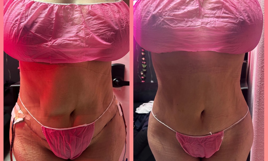 Image 1: Embrace a comprehensive Post-op care (after lipo/ bbl/ tummy tucks)