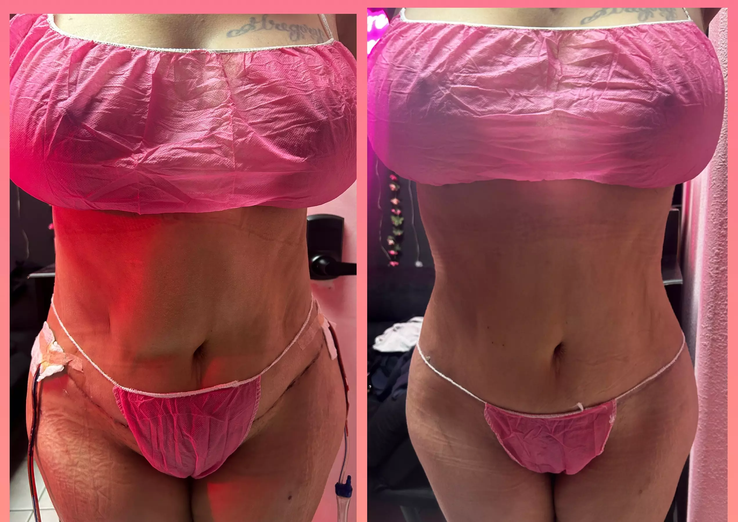 Embrace a comprehensive Post-op care (after lipo/ bbl/ tummy tucks)