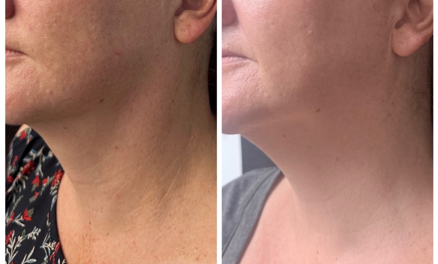Image 3: Revitalize Your Skin with BBGlow, Chemical Peel, or Microneedling