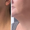 Image 3: Revitalize Your Skin with BBGlow, Chemical Peel, or Microneedling