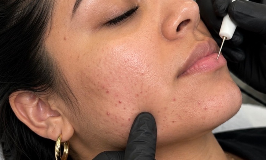 Image 3: Targeted Facial Hair Electrolysis: 45, 60, or 90-Min Sessions