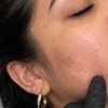Image 3: Targeted Facial Hair Electrolysis: 45, 60, or 90-Min Sessions