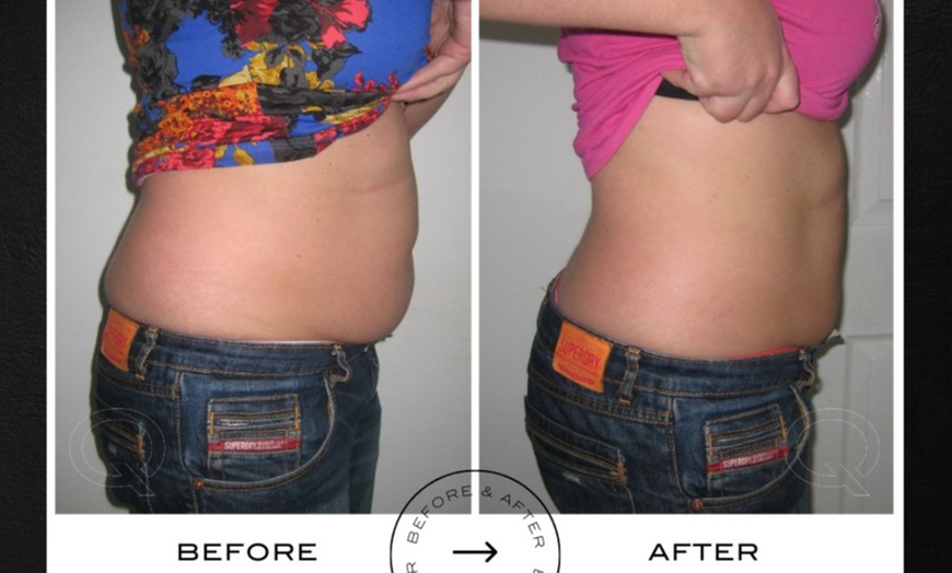Image 7: Up to 73% Off on Ultrasonic Fat Reduction at LAMURE Aesthetic Clinic