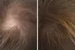 Scalp Micropigmentation Hair-Loss Treatment - Crown, Front, or Filler (Density Effect) - Women/Men(Up to 44%Off) - Second Medium