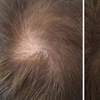 Image 6: Scalp Micropigmentation Hair-Loss Treatment - Crown, Front, or Filler