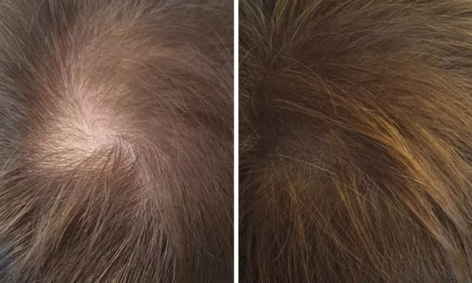 Scalp Micropigmentation Hair-Loss Treatment - Crown, Front, or Filler