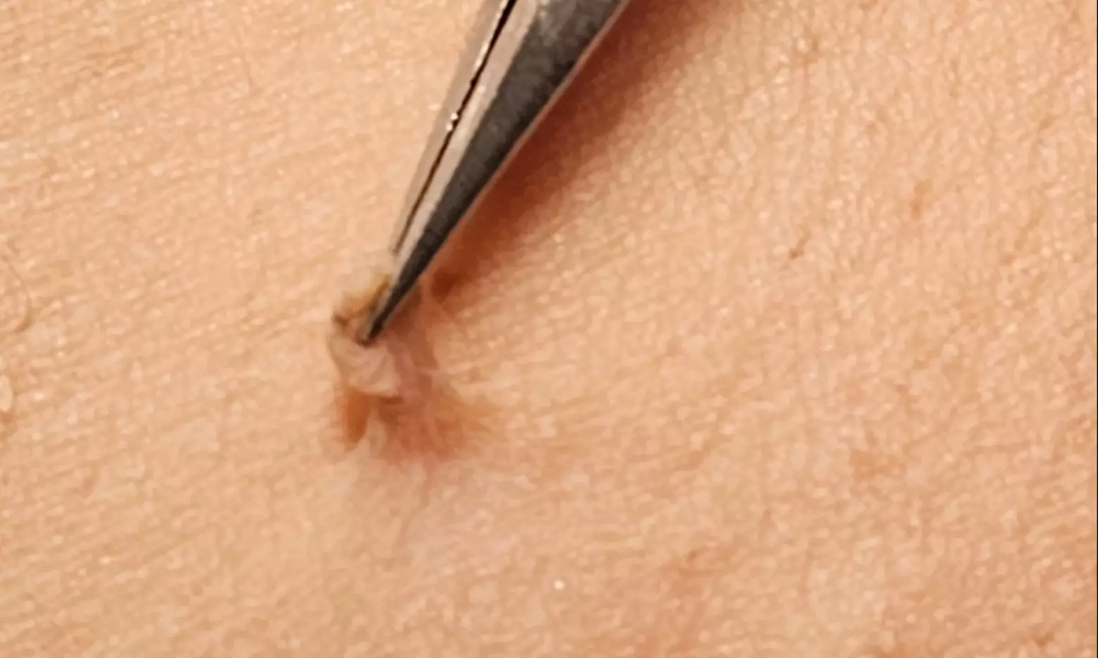 Achieve Smooth Skin with Med Therapy and Spa's Efficient Tag Removal up to 42%