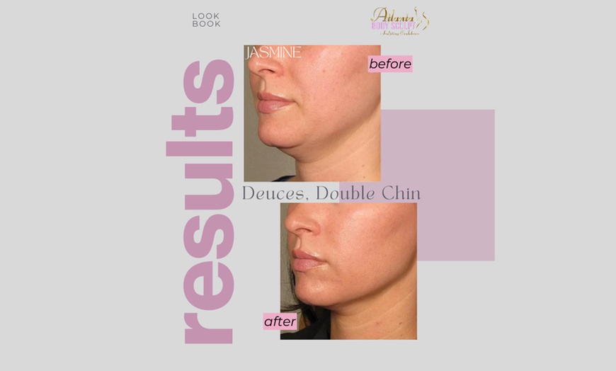 Image 2: Therma-Lift Facelifts for Youthful Skin with No Downtime