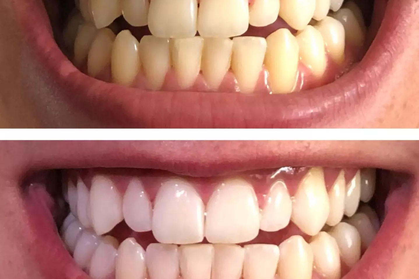 Get a Brighter Smile with Basic or Deluxe Whitening