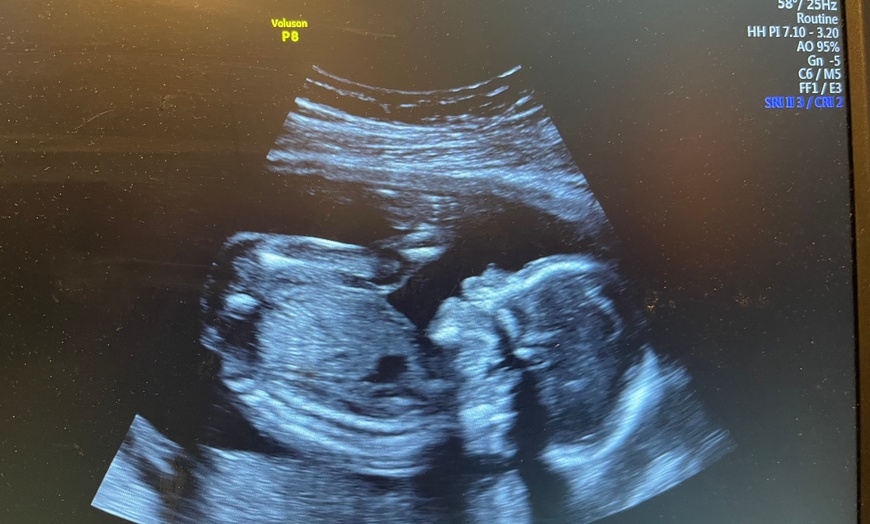 Image 5: Capture Precious Moments with Multi Visit 2D Ultrasound