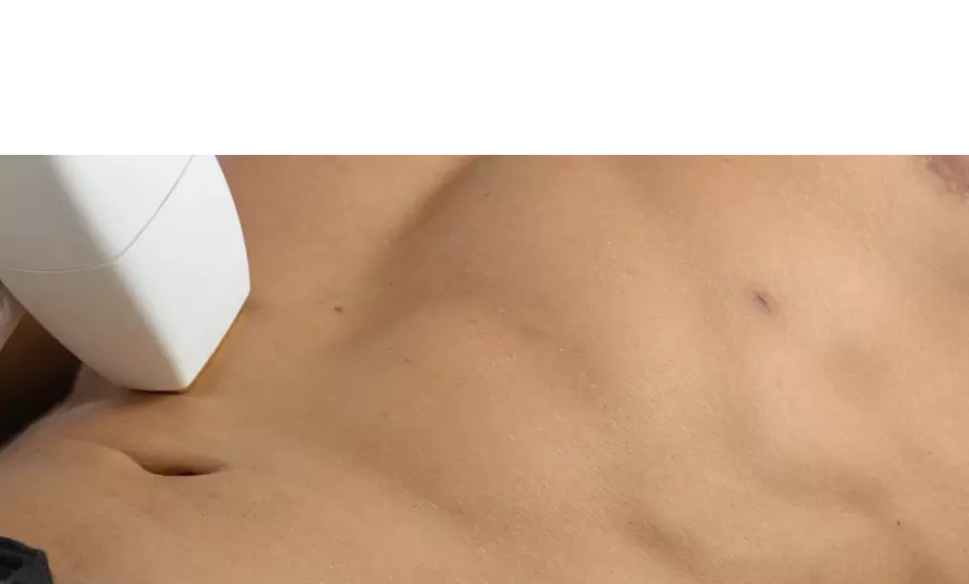 Image 2: Say Goodbye To Unwanted Hair: Laser Hair Removal