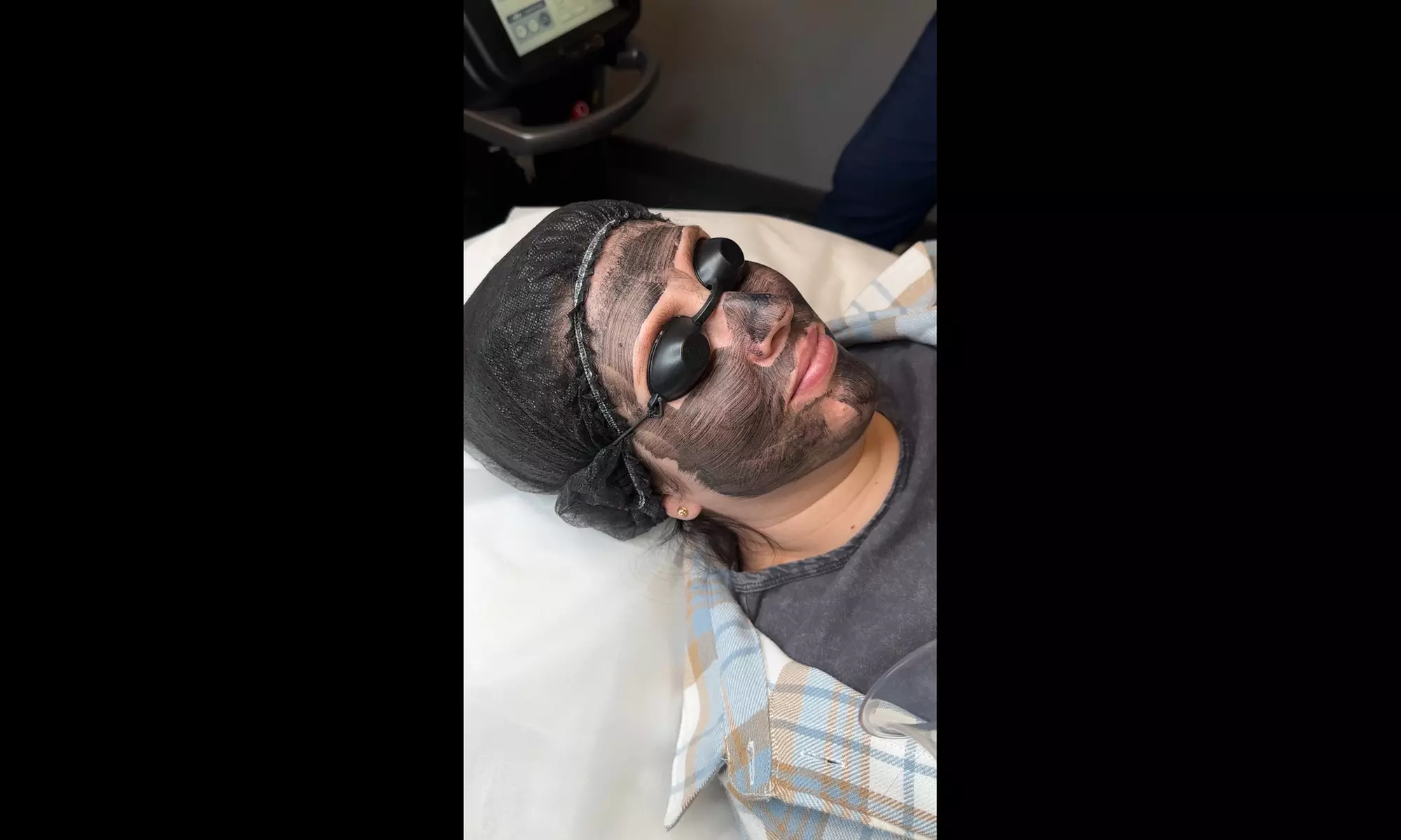 Glow Up with Carbon Laser Peel for Face & Neck