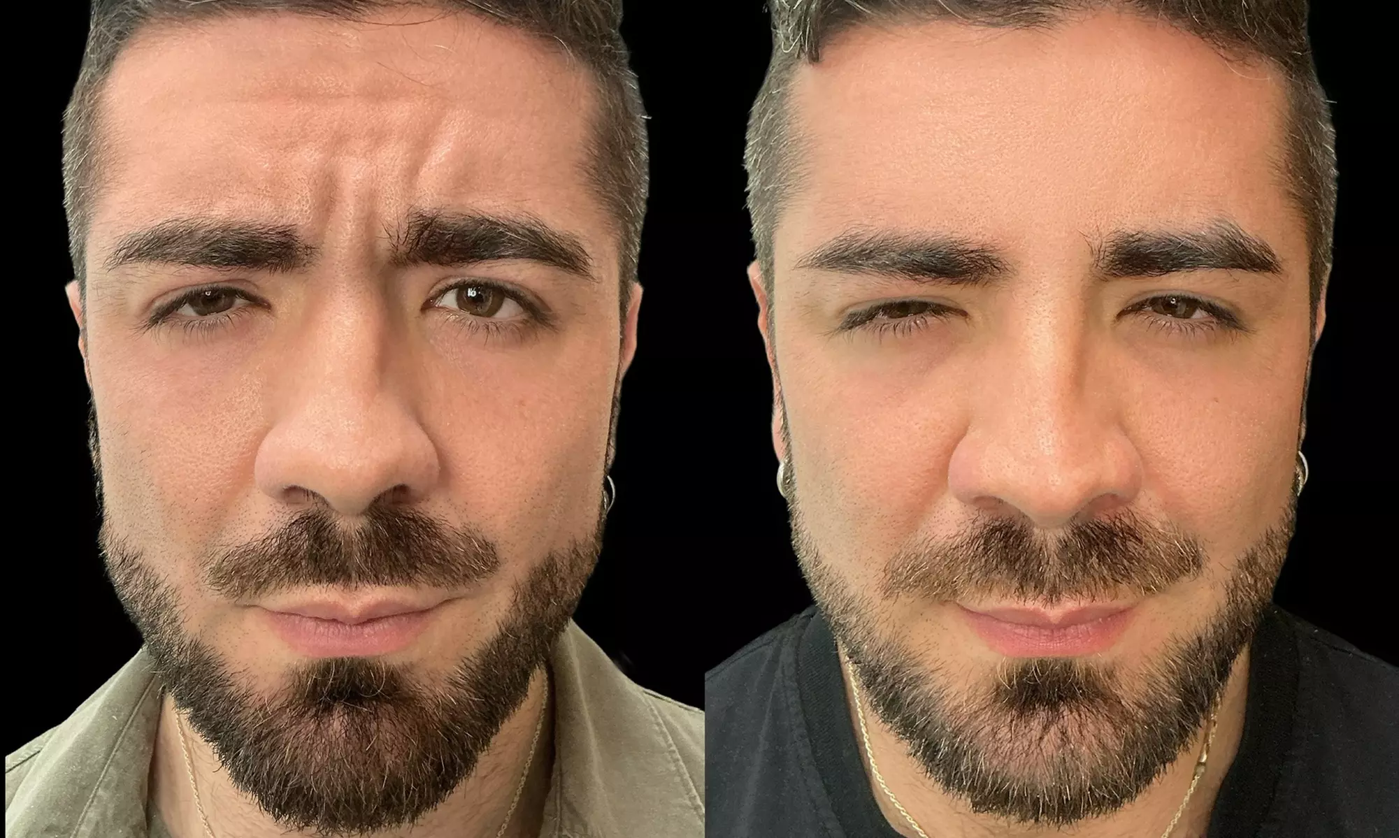 Smooth Away Lines with Botox Lip Flip, 20 or 40 Units of Botox