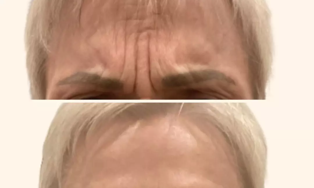 Up to 31% Off on Injection - Xeomin at Get Tox'd Medspa