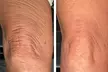 One or Three Sessions of TetraPRO or CoolPeel CO2 Fractional Laser on Choice of Treatment Areas (Up to 50% Off) - Second Medium