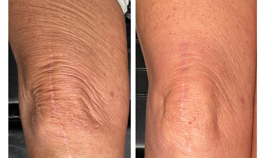 Image 2: One or Three Sessions of TetraPRO or CoolPeel CO2 Fractional Laser on Choice of Treatment Areas (Up to 50% Off)